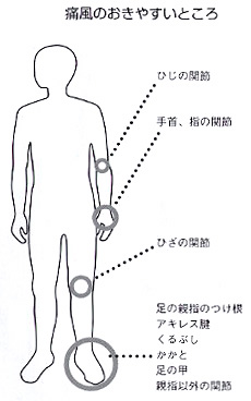 痛風 女性 初期 症状