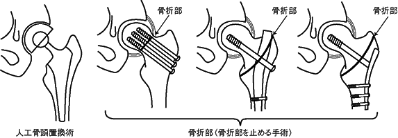 特集２ 股関節の骨折と病気 体重を支える大事な関節 全日本民医連