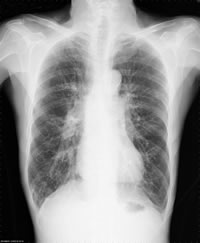 特集2 慢性呼吸不全 確実な予防 治療法は禁煙のみ 知らぬ間に病状がすすむことも 全日本民医連