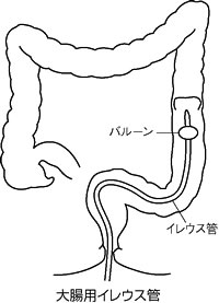 特集２ 腸閉塞ってどんな病気 おう吐 腹痛 排便 排ガス停止 我慢せず 早めに病院へ 青森 健生病院外科科長 鈴木隆太 全日本民医連