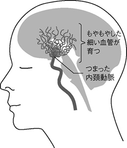 特集2 頭痛にご用心 上 あごの関節や目の痛みも原因に いつもと違う ときは要注意 全日本民医連