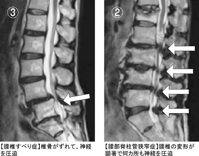 特集２ 原因もさまざま あなどれない腰痛 全日本民医連