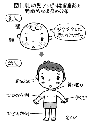 特集２ アトピー性皮膚炎 悪化誘因対策が大切 ステロイド軟こうも上手に使って 全日本民医連