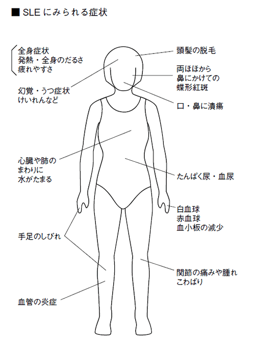 特集２ 全身性エリテマトーデス 膠原病の代表的な病気の一つ 全日本民医連