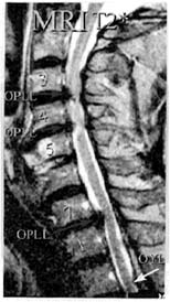 医療研究室 難病 頚椎後縦靭帯骨化症の手術療法 全日本民医連