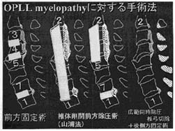 医療研究室 難病 頚椎後縦靭帯骨化症の手術療法 全日本民医連