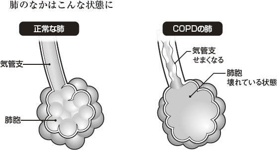 けんこう教室 ｃｏｐｄ 慢性閉塞性肺疾患 患者は人に１人と推定 咳 たん 息苦しさはありませんか 全日本民医連