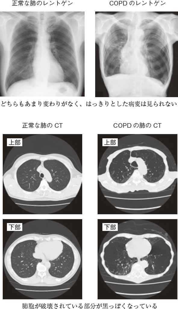 けんこう教室 ｃｏｐｄ 慢性閉塞性肺疾患 患者は人に１人と推定 咳 たん 息苦しさはありませんか 全日本民医連