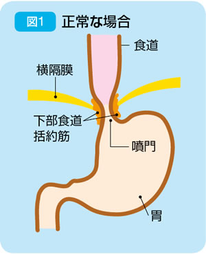 胸焼け 肺炎