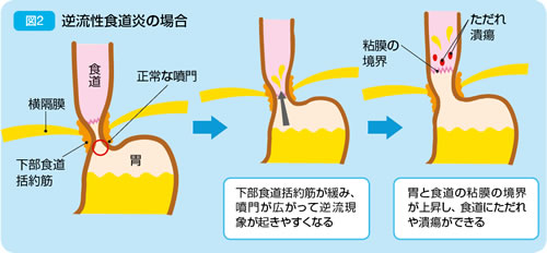 胸焼け 肺炎