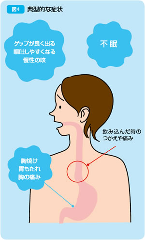 ゲップ が よく 出る 喉 に 違和感