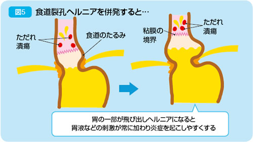 対処 胸焼け 胸焼けで困った？即効で効いた簡単な３つの治し方！