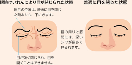 けんこう教室 まばたきできていますか 眼瞼けいれん 全日本民医連