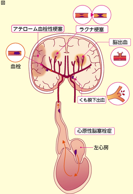 出血 期間 前兆 下 くも膜