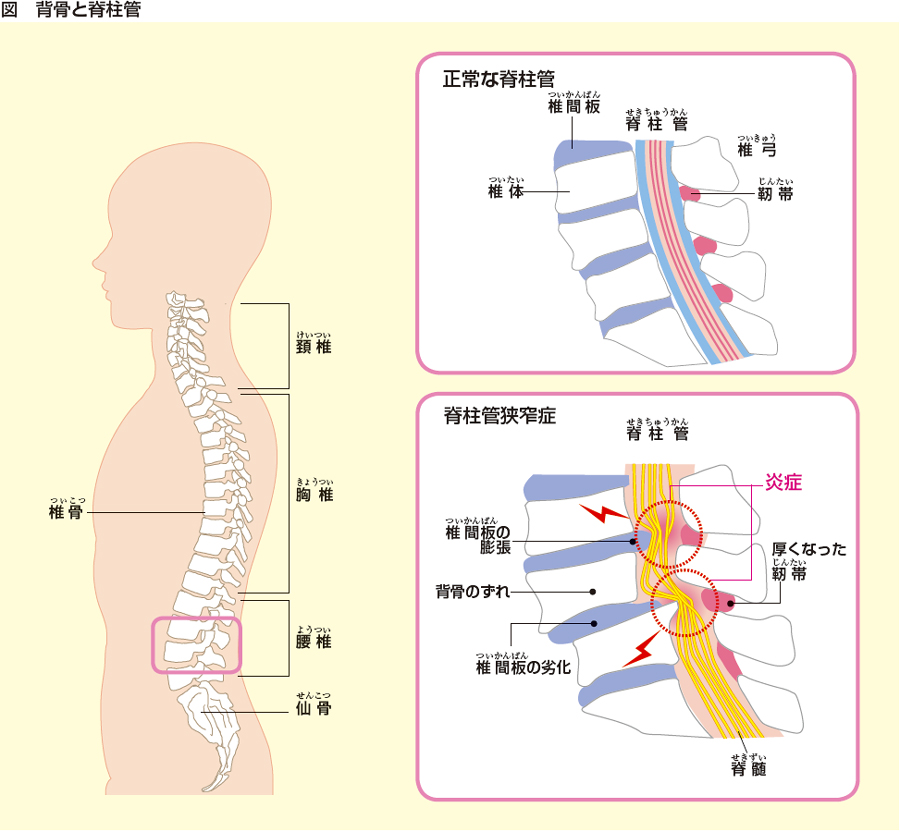 症 狭窄 脊椎 管